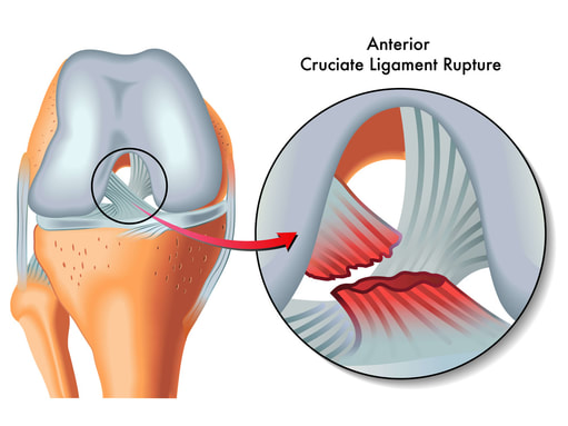 ACL, anterior cruciate ligament, ligament, knee pain, knee surgery